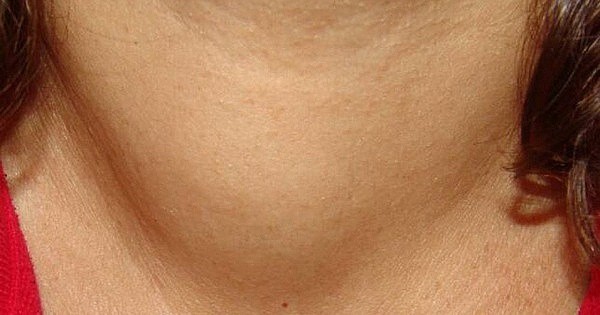 Các bệnh viêm tuyến giáp Các bệnh viêm tuyến giáp