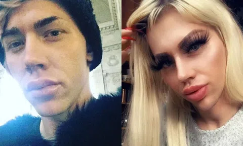 Chàng trai chi 19.000 USD phẫu thuật giống búp bê Barbie