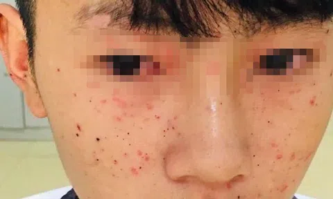 3 học sinh Hà Tĩnh phải nhập viện cấp cứu vì laptop bị nổ