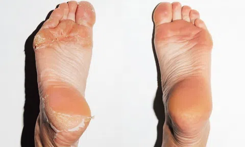 8 cách chữa nứt nẻ gót chân tại nhà