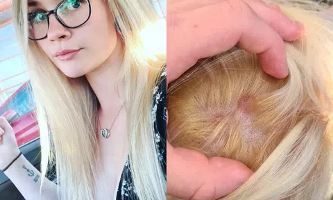 Cô gái phồng rộp da đầu sau khi tẩy tóc tại nhà