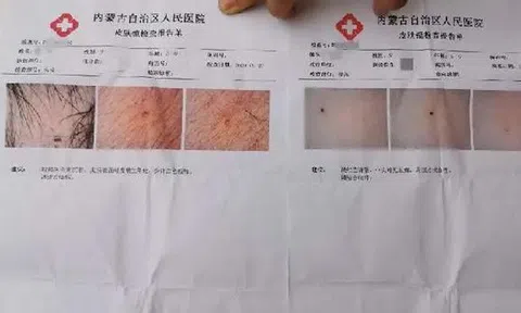 Ba giáo viên Trung Quốc bị bắt vì đâm kim vào người học sinh