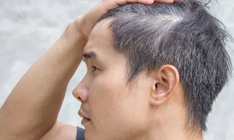 7 nguyên nhân khiến người trẻ có tóc bạc