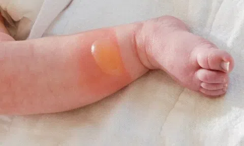 Bé trai 12 tháng bị hoại tử nặng vì bố mẹ tự ý đắp lá vào vết bỏng