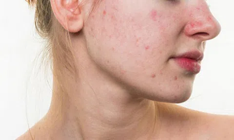 Tác dụng phụ thường gặp sau điều trị sẹo rỗ