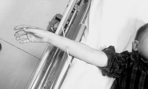 Đùa nghịch sau khi ăn, bé trai bị que xiên thịt đâm xuyên cẳng tay