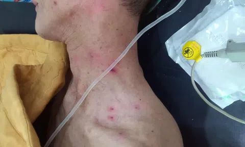 Hai bố con bị hàng trăm con ong rừng đốt