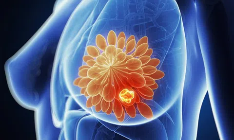 Australia cung cấp nền tảng công nghệ mới giúp cải thiện chẩn đoán ung thư vú tại Việt Nam