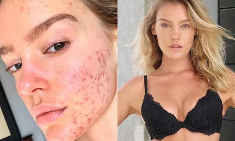Nữ người mẫu tiết lộ cách chữa hết mụn