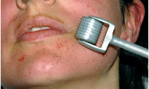 Hiểm họa khi tự lăn kim trị sẹo tại nhà